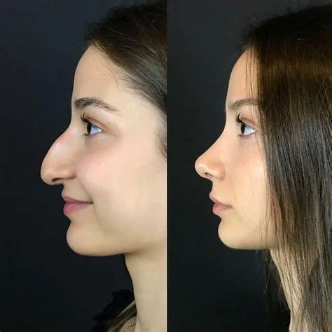 is this normal is it just swollen will it go down Dr. . Piggy nose after rhinoplasty reddit